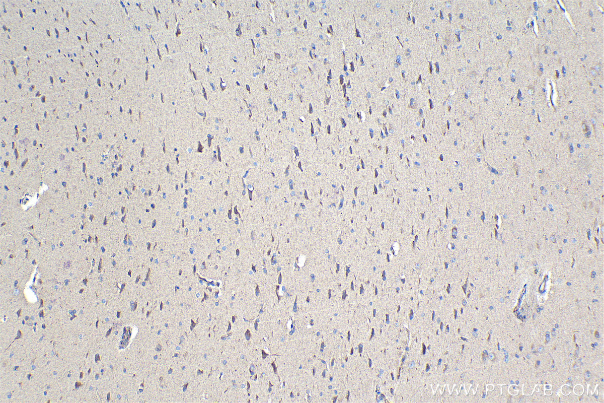 Immunohistochemical analysis of paraffin-embedded human gliomas tissue slide using KHC0988 (DCTN1 IHC Kit).