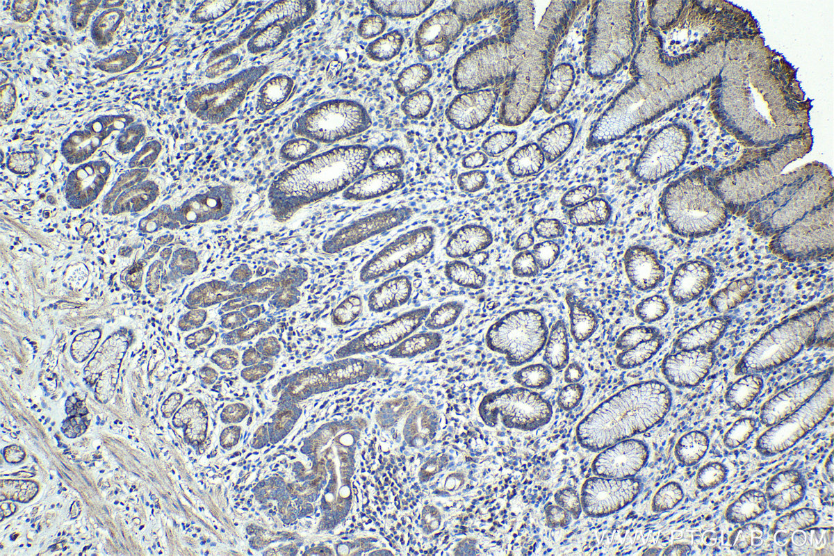 Immunohistochemical analysis of paraffin-embedded human stomach cancer tissue slide using KHC0988 (DCTN1 IHC Kit).