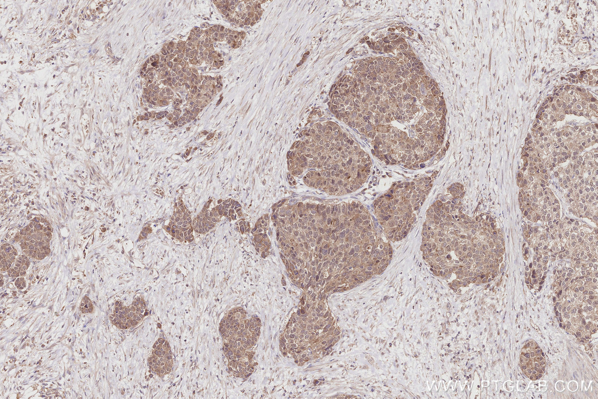 Immunohistochemical analysis of paraffin-embedded human stomach cancer tissue slide using KHC2866 (DCTN5 IHC Kit).