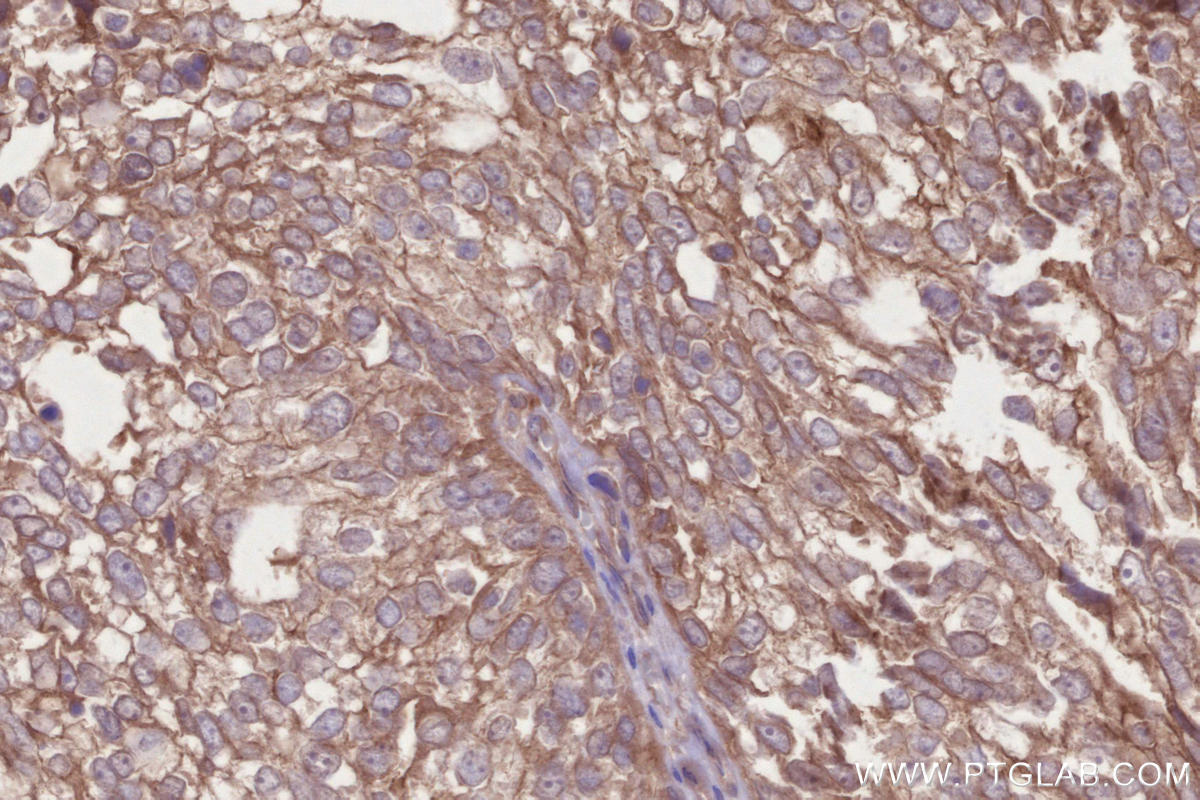 Immunohistochemical analysis of paraffin-embedded human ovary cancer tissue slide using KHC2651 (DCUN1D3 IHC Kit).