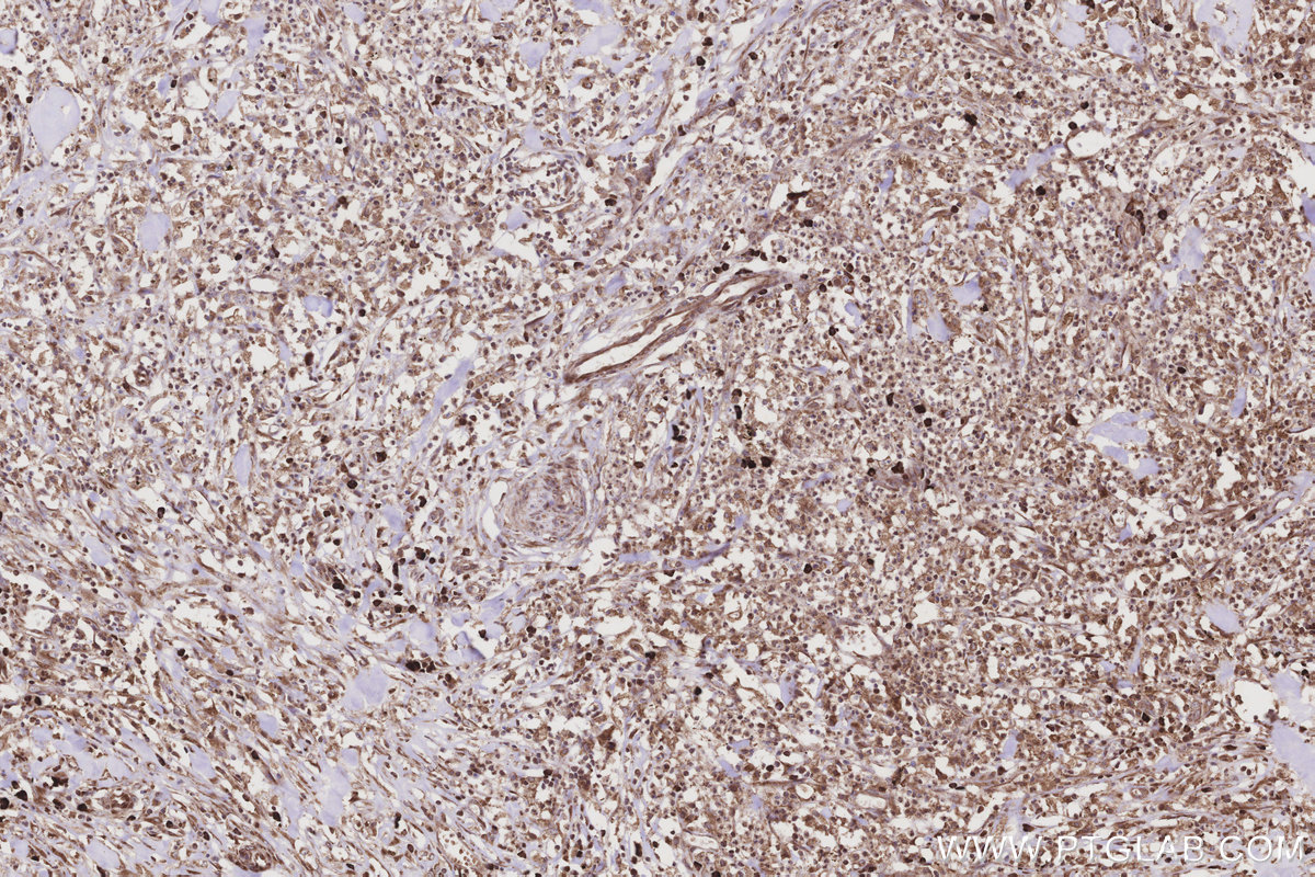 Immunohistochemical analysis of paraffin-embedded human colon cancer tissue slide using KHC3208 (DDOST IHC Kit). Immunohistochemical analysis of paraffin-embedded human colon cancer tissue slide using KHC3208 (DDOST IHC Kit).