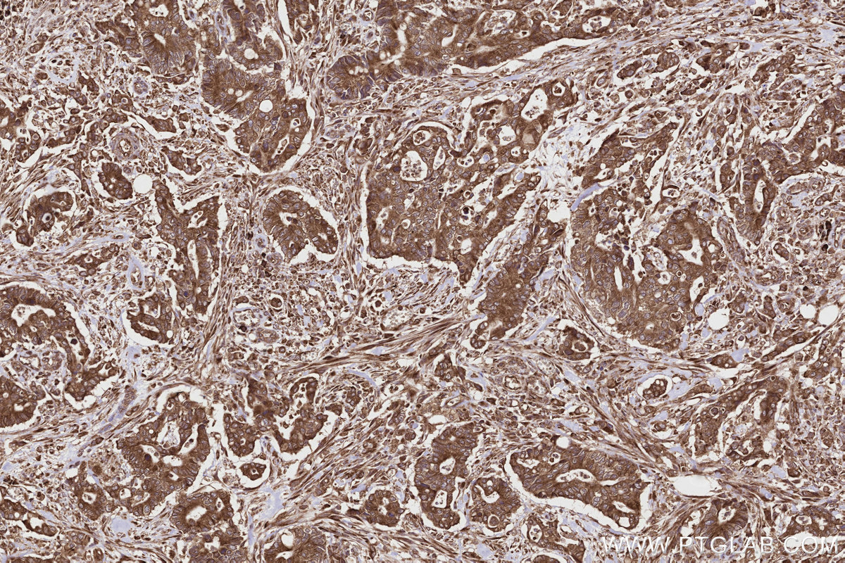 Immunohistochemical analysis of paraffin-embedded human rectal cancer tissue slide using KHC2799 (DDRGK1 IHC Kit).