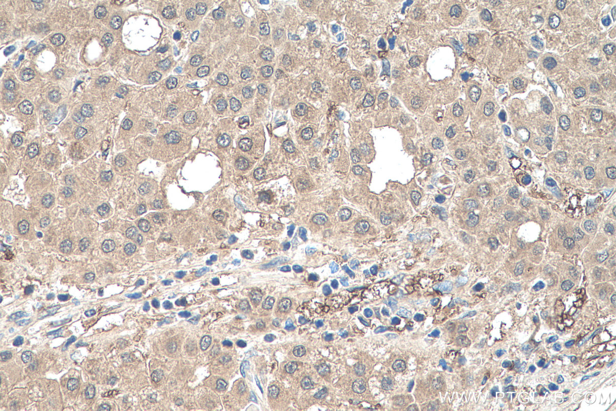 Immunohistochemical analysis of paraffin-embedded human liver cancer tissue slide using KHC0527 (DDT IHC Kit).