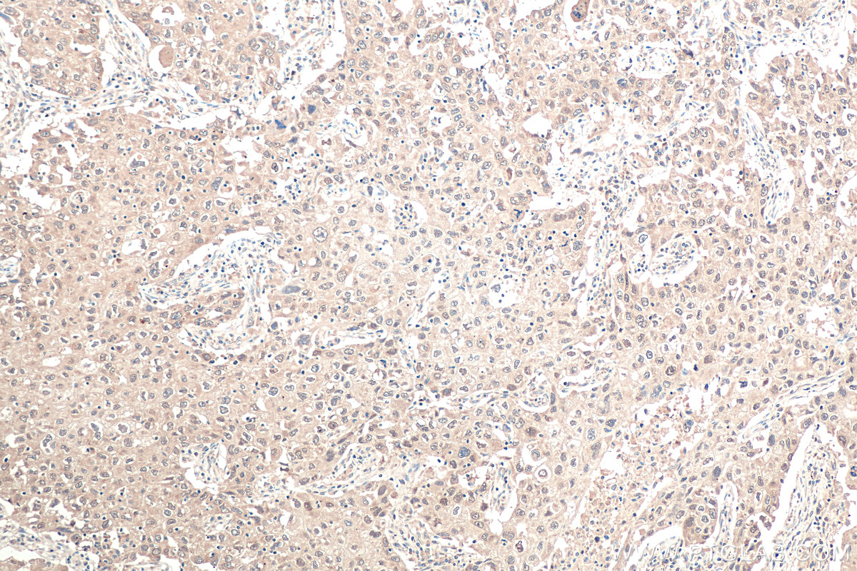 Immunohistochemical analysis of paraffin-embedded human lung cancer tissue slide using KHC0913 (DDX5 IHC Kit).