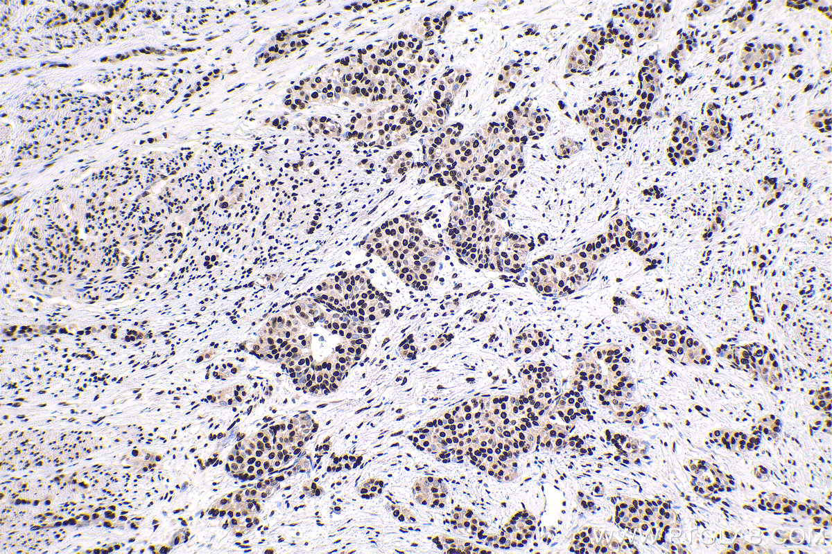 Immunohistochemical analysis of paraffin-embedded human urothelial carcinoma tissue slide using KHC1685 (DHX9 IHC Kit).