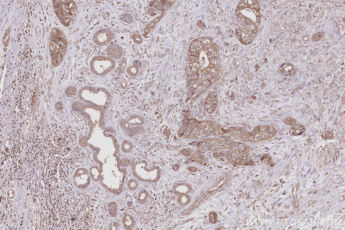 Immunohistochemical analysis of paraffin-embedded human pancreas cancer tissue slide using KHC2954 (DIAPH3 IHC Kit).