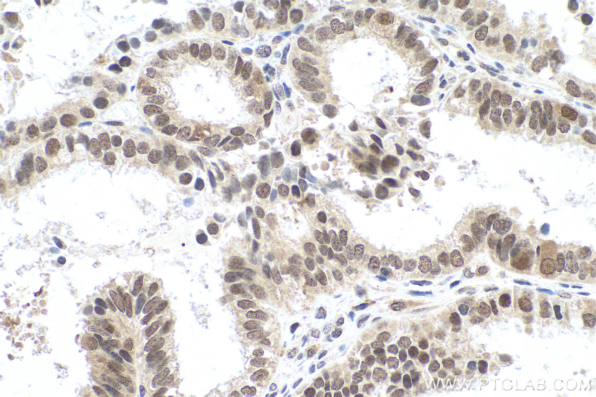 Immunohistochemical analysis of paraffin-embedded human ovary tumor tissue slide using KHC0813 (DIDO1 IHC Kit).