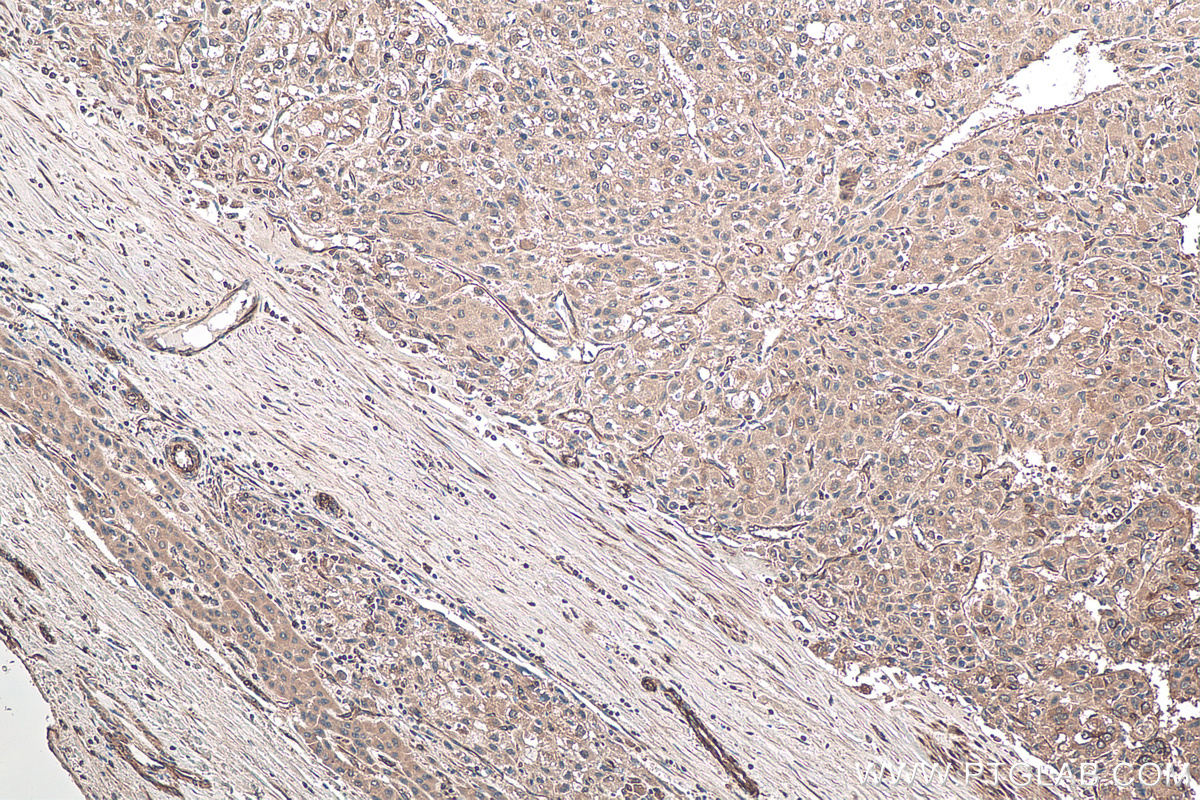 Immunohistochemical analysis of paraffin-embedded human liver cancer tissue slide using KHC0119 (DKK3 IHC Kit).