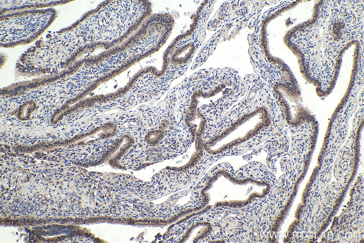 Immunohistochemical analysis of paraffin-embedded human ovary tumor tissue slide using KHC1953 (DMAP1 IHC Kit).