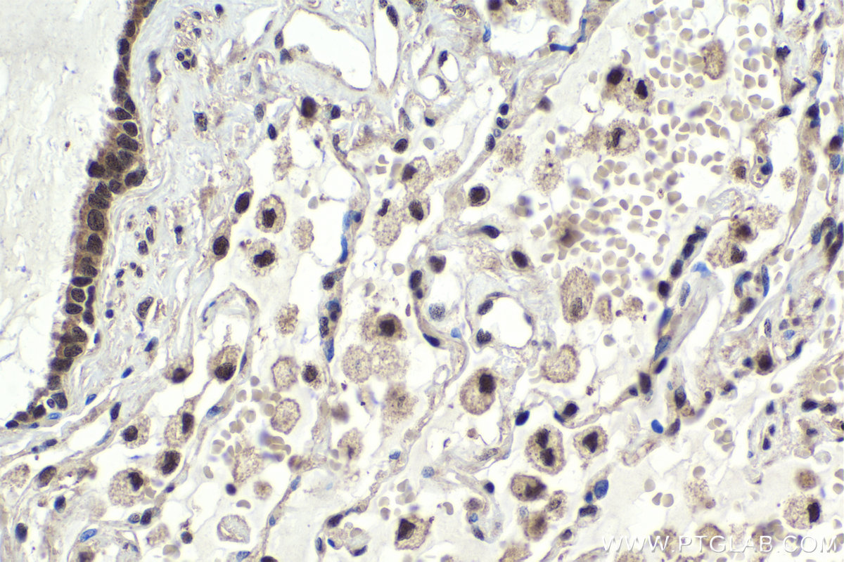 Immunohistochemical analysis of paraffin-embedded human lung cancer tissue slide using KHC1953 (DMAP1 IHC Kit).