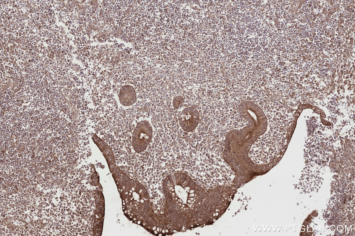 Immunohistochemical analysis of paraffin-embedded human appendicitis tissue slide using KHC2718 (DMXL2 IHC Kit).