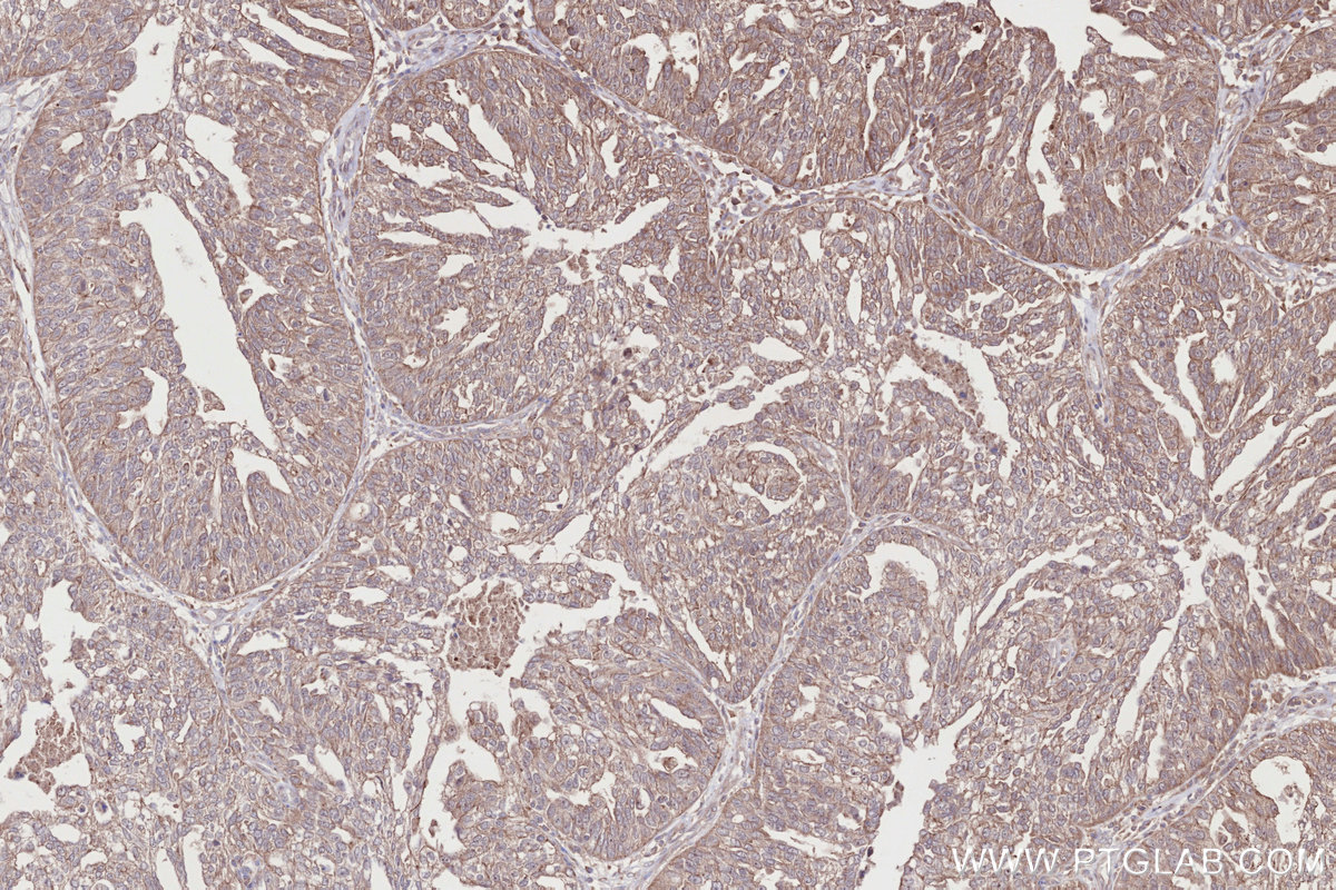 Immunohistochemical analysis of paraffin-embedded human ovary cancer tissue slide using KHC2718 (DMXL2 IHC Kit).