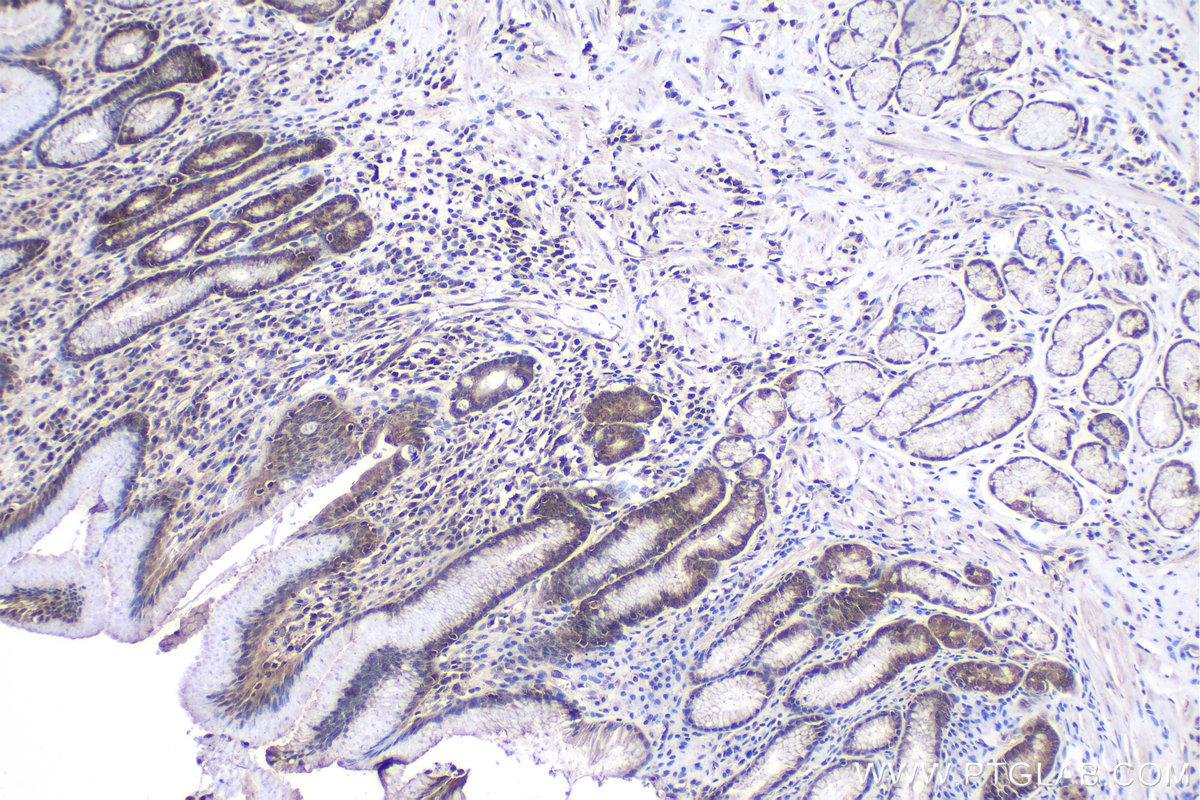 Immunohistochemical analysis of paraffin-embedded human stomach cancer tissue slide using KHC1040 (DNAJA2 IHC Kit).