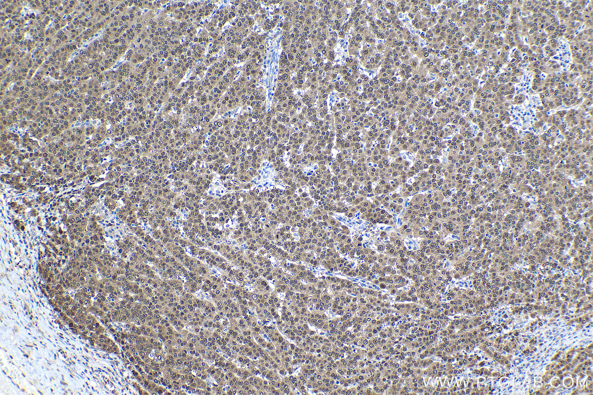 Immunohistochemical analysis of paraffin-embedded human ovary tumor tissue slide using KHC1128 (DNAJB1 IHC Kit).