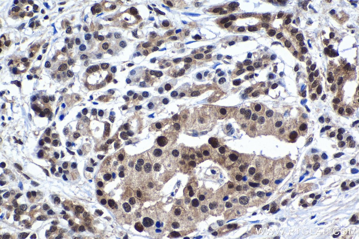 Immunohistochemical analysis of paraffin-embedded human pancreas cancer tissue slide using KHC1128 (DNAJB1 IHC Kit).