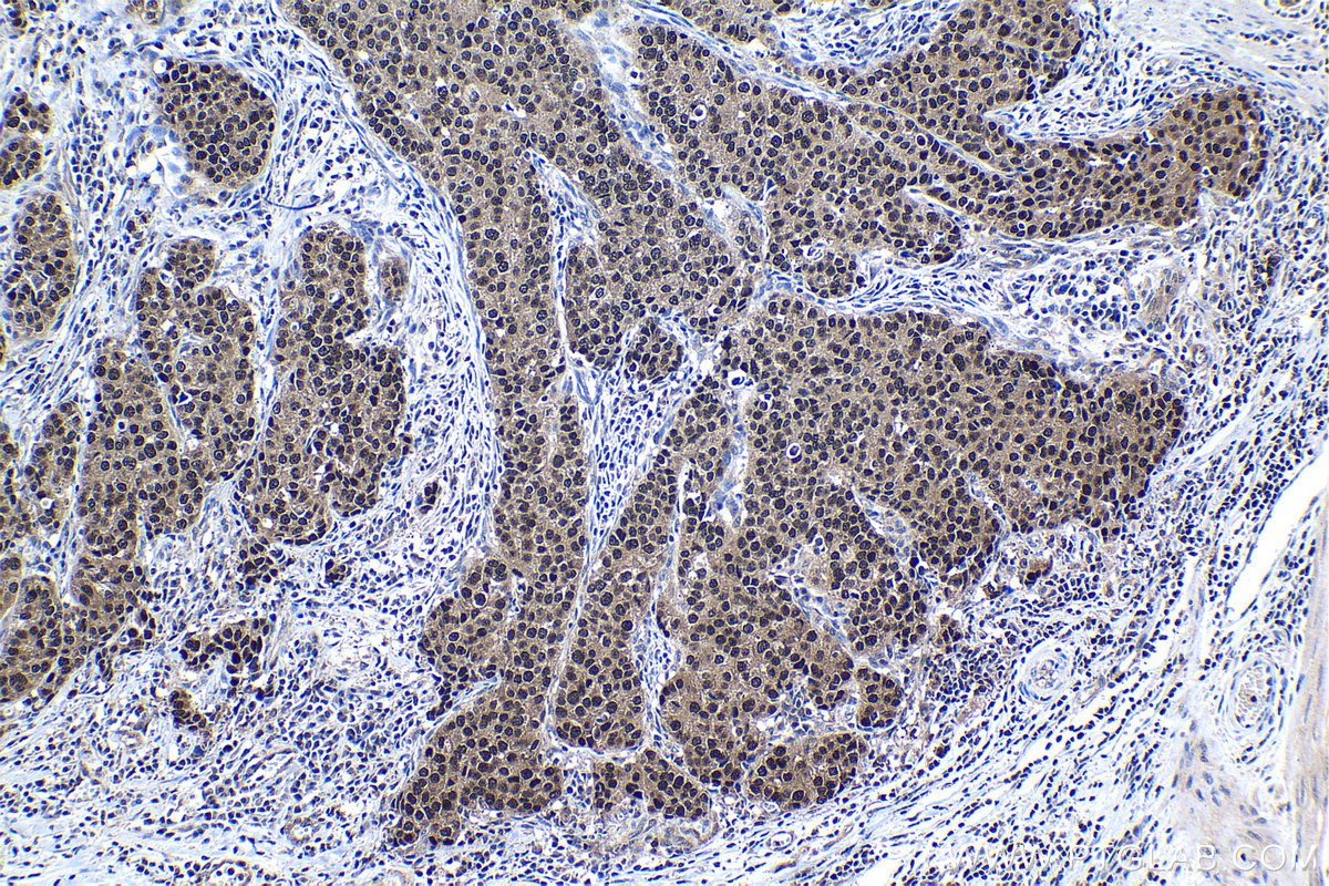 Immunohistochemical analysis of paraffin-embedded human stomach cancer tissue slide using KHC1128 (DNAJB1 IHC Kit).