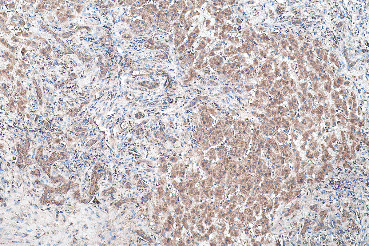 Immunohistochemical analysis of paraffin-embedded human liver cancer tissue slide using KHC0414 (DNAJC12 IHC Kit).