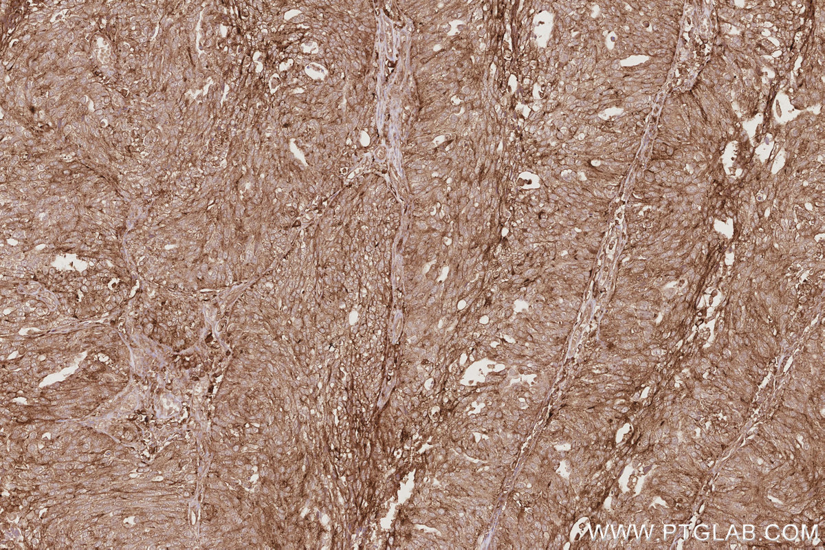 Immunohistochemical analysis of paraffin-embedded human ovary cancer tissue slide using KHC2914 (DNAJC5 IHC Kit).