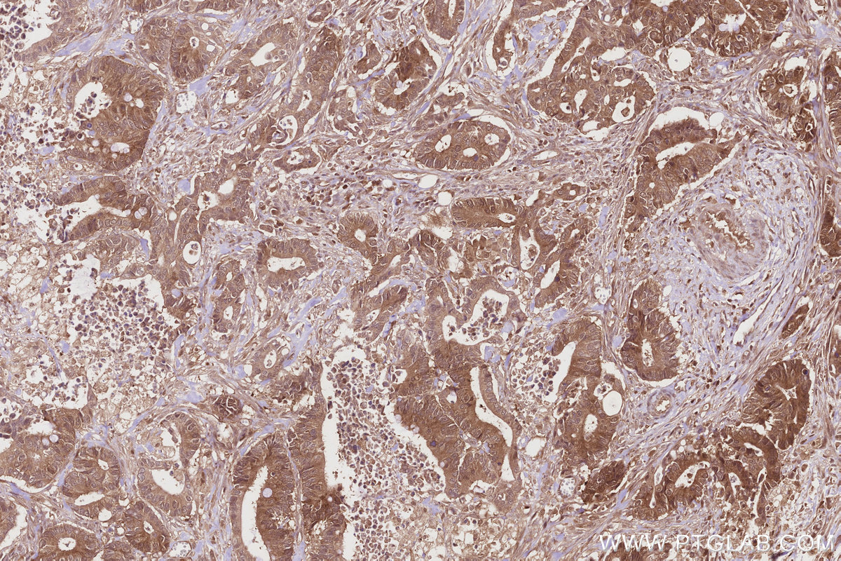 Immunohistochemical analysis of paraffin-embedded human rectal cancer tissue slide using KHC2844 (DNAJC7 IHC Kit).