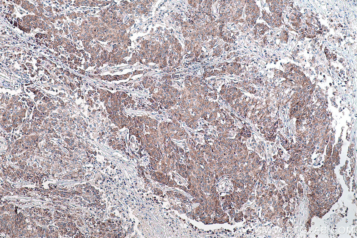 Immunohistochemical analysis of paraffin-embedded human stomach cancer tissue slide using KHC0174 (DNMT3A IHC Kit).