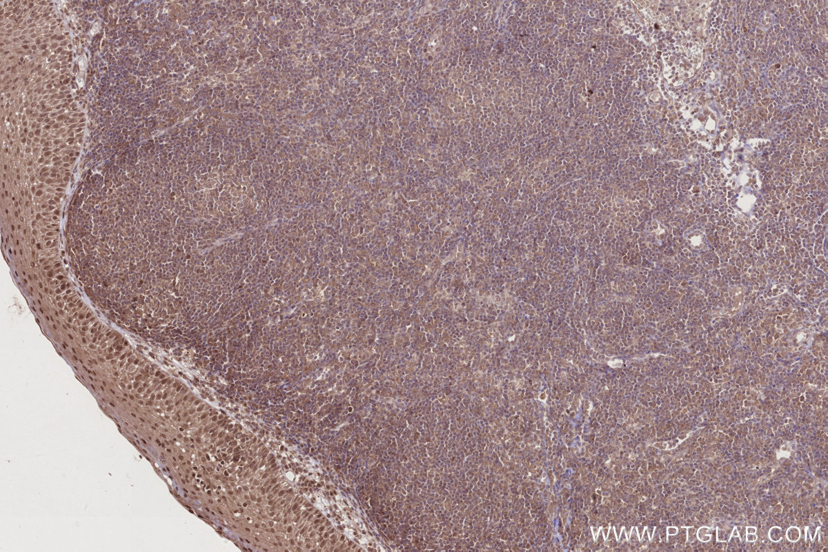 Immunohistochemical analysis of paraffin-embedded human tonsillitis tissue slide using KHC2780 (DOCK10 IHC Kit).