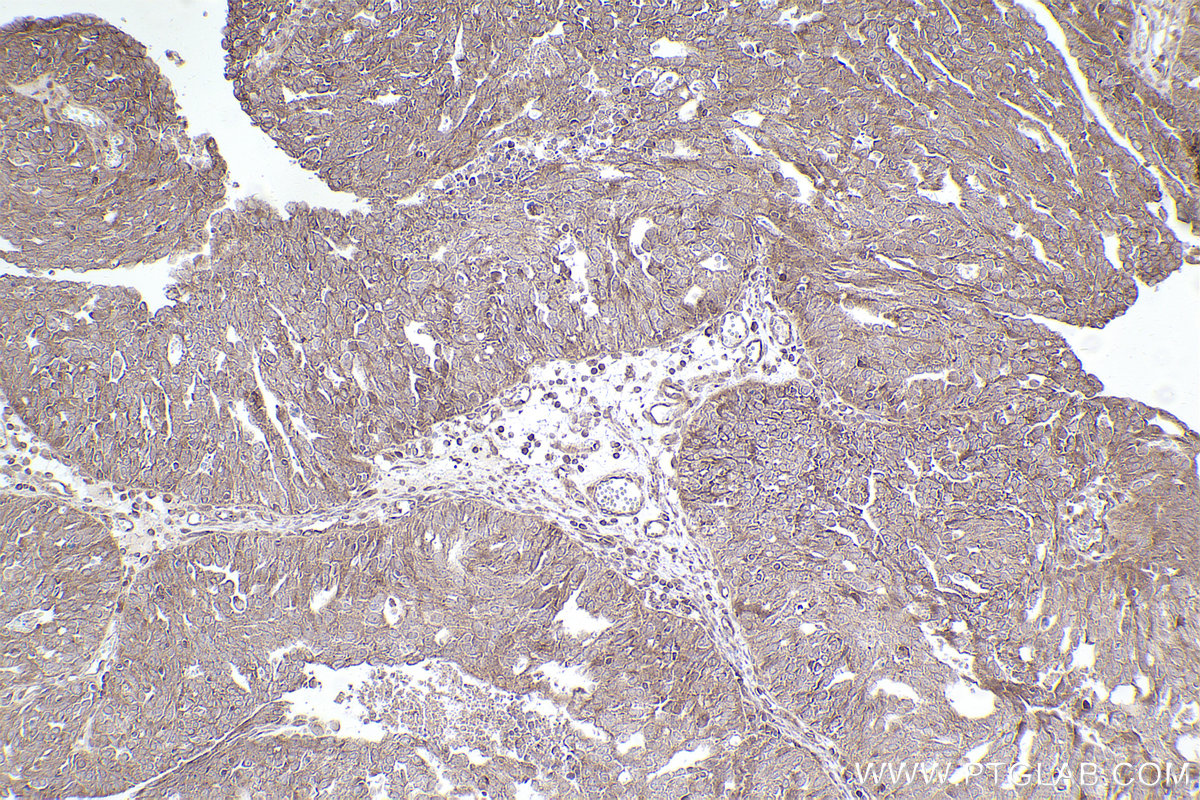 Immunohistochemical analysis of paraffin-embedded human ovary cancer tissue slide using KHC2544 (DOCK11 IHC Kit).