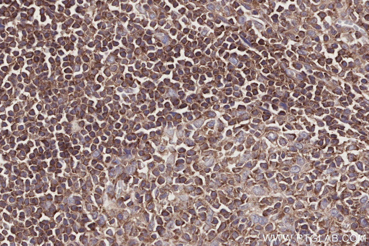 Immunohistochemical analysis of paraffin-embedded human appendicitis tissue slide using KHC2747 (DOCK2 IHC Kit).