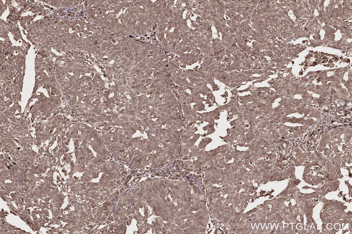 Immunohistochemical analysis of paraffin-embedded human ovary cancer tissue slide using KHC2663 (DOCK3 IHC Kit).