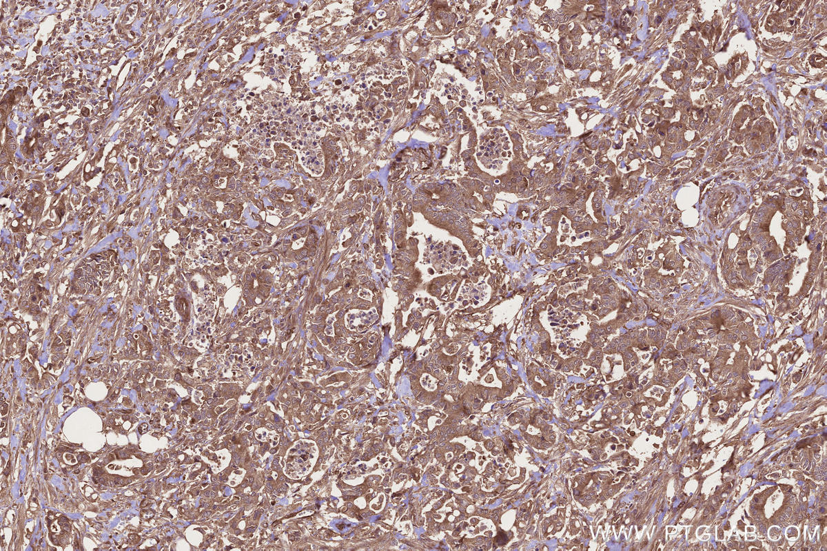 Immunohistochemical analysis of paraffin-embedded human rectal cancer tissue slide using KHC2668 (DOCK4 IHC Kit).