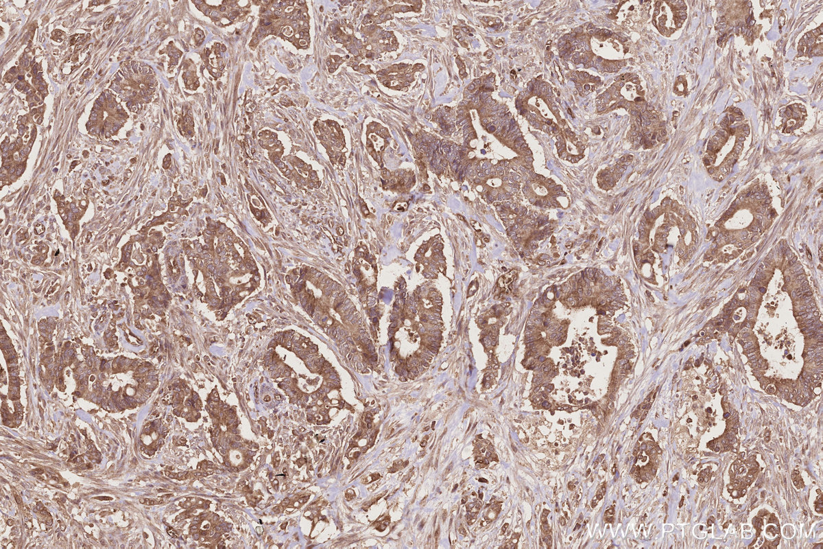 Immunohistochemical analysis of paraffin-embedded human rectal cancer tissue slide using KHC2797 (DOCK6 IHC Kit).