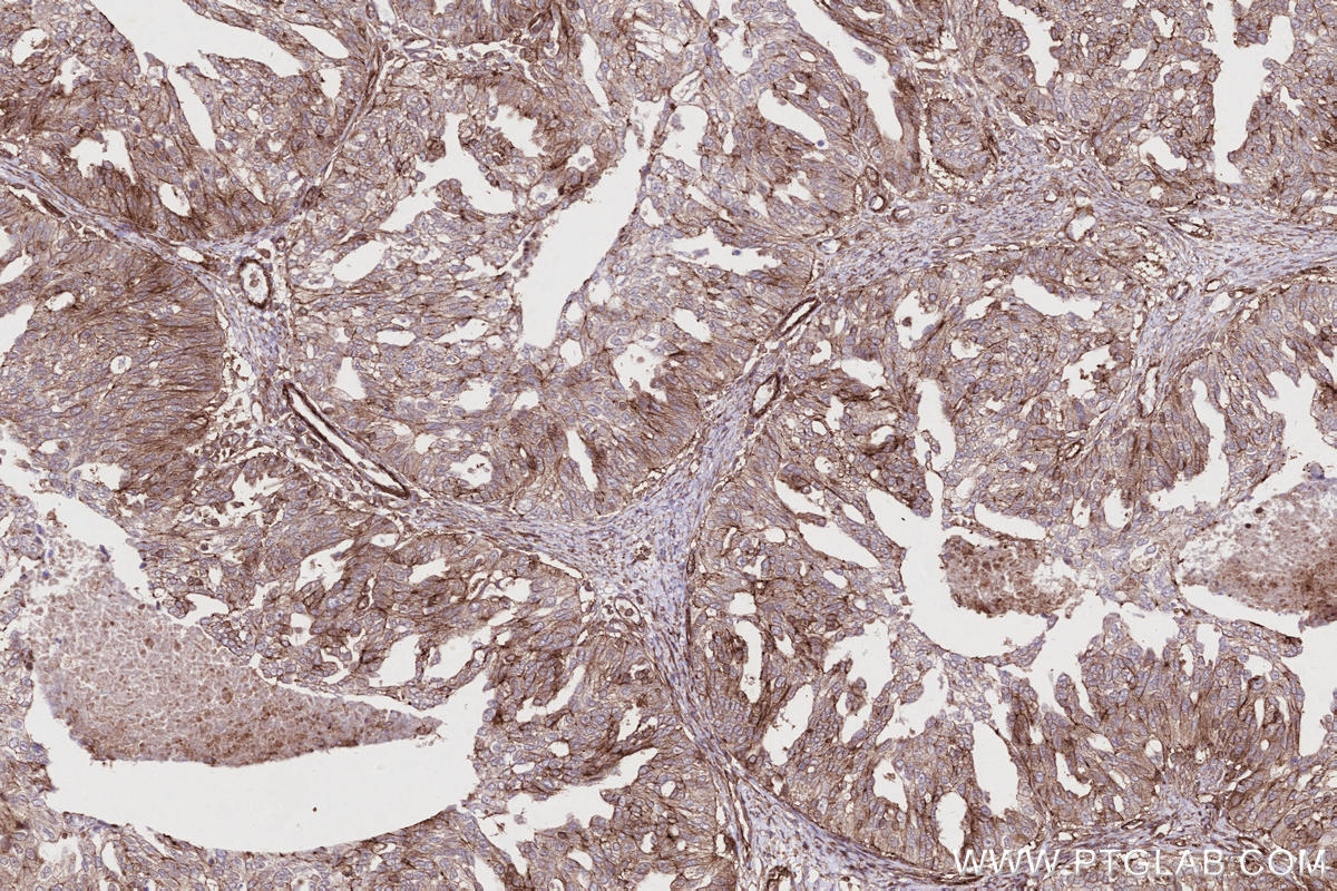 Immunohistochemical analysis of paraffin-embedded human ovary cancer tissue slide using KHC2694 (DOCK8 IHC Kit).