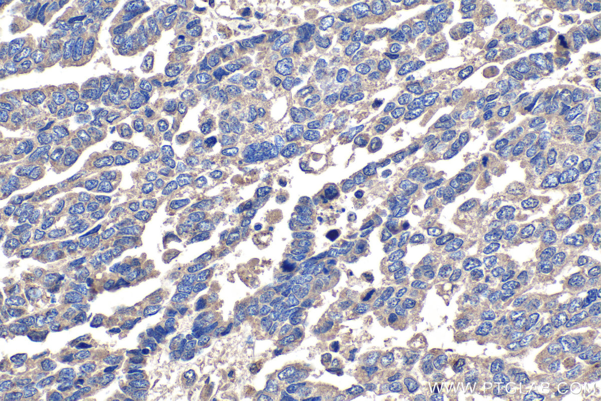 Immunohistochemical analysis of paraffin-embedded human ovary tumor tissue slide using KHC1340 (DSE IHC Kit).