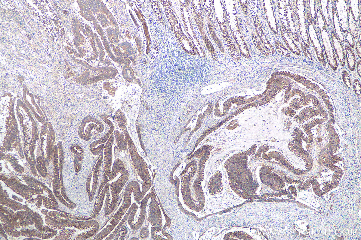 Immunohistochemical analysis of paraffin-embedded human colon cancer tissue slide using KHC0105 (DSG2 IHC Kit).