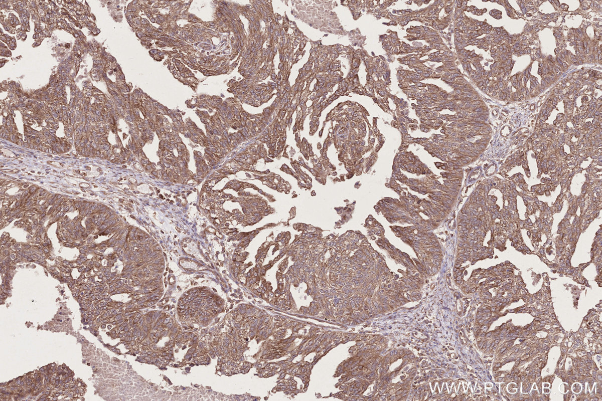Immunohistochemical analysis of paraffin-embedded human ovary cancer tissue slide using KHC2717 (DTX3L IHC Kit).