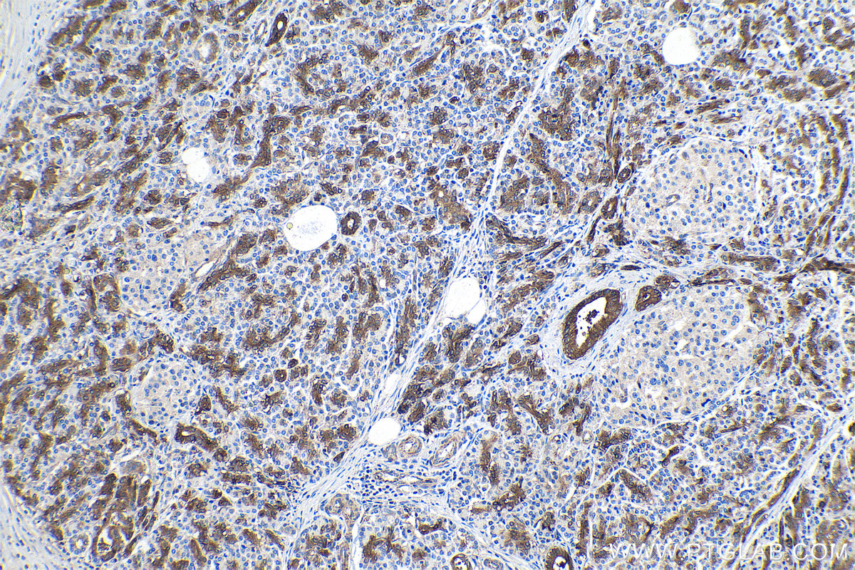 Immunohistochemical analysis of paraffin-embedded human pancreas cancer tissue slide using KHC1403 (DTYMK IHC Kit).