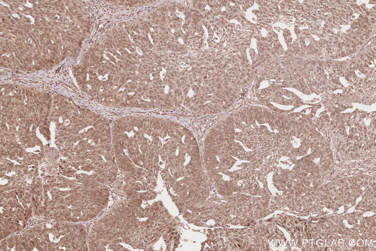 Immunohistochemical analysis of paraffin-embedded human ovary cancer tissue slide using KHC2595 (DUB3 IHC Kit).