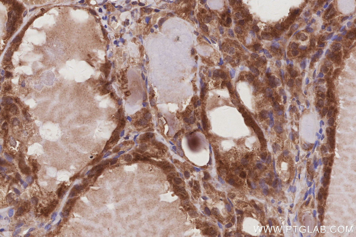 Immunohistochemical analysis of paraffin-embedded human thyroid cancer tissue slide using KHC3014 (DUSP13 IHC Kit).
