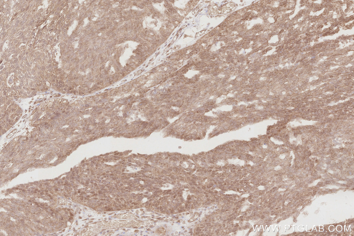 Immunohistochemical analysis of paraffin-embedded human ovary cancer tissue slide using KHC2885 (DUSP16 IHC Kit).