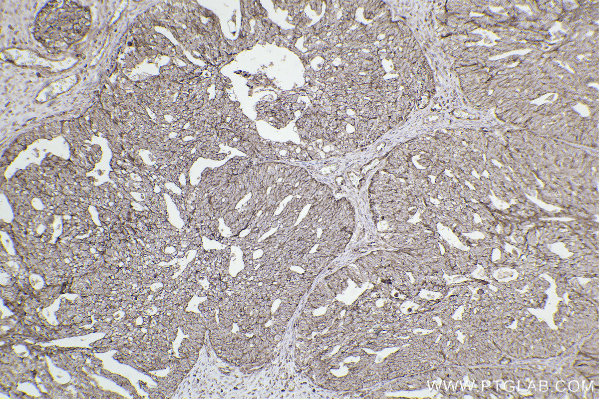 Immunohistochemical analysis of paraffin-embedded human ovary cancer tissue slide using KHC2521 (DUSP6 IHC Kit).