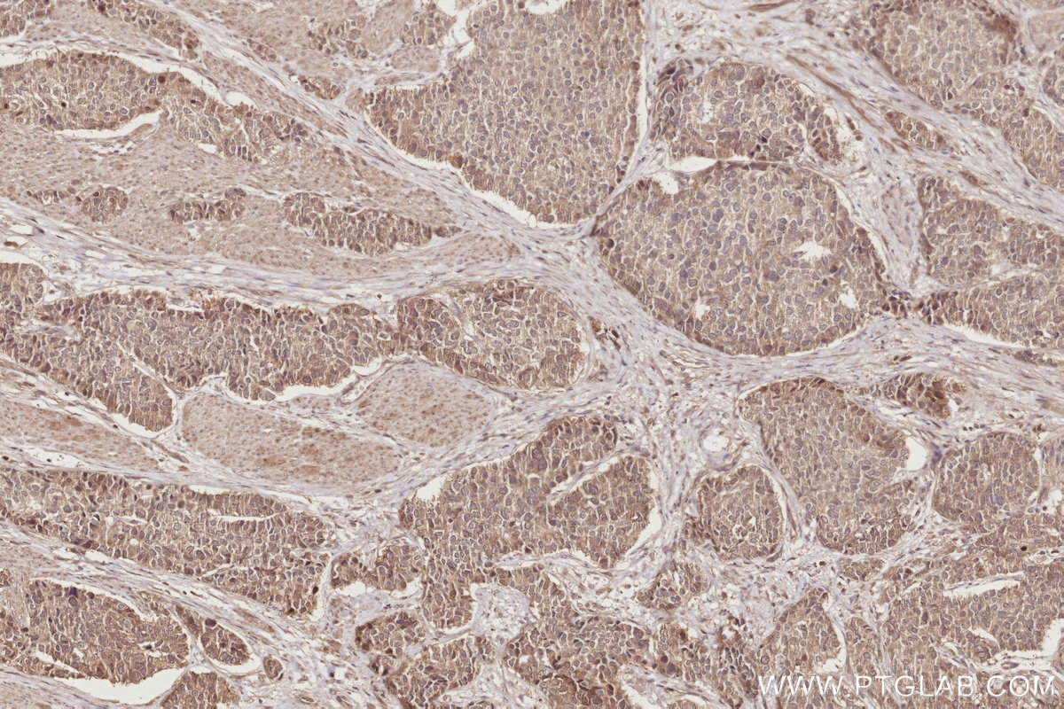 Immunohistochemical analysis of paraffin-embedded human stomach cancer tissue slide using KHC2850 (DUSP9 IHC Kit).