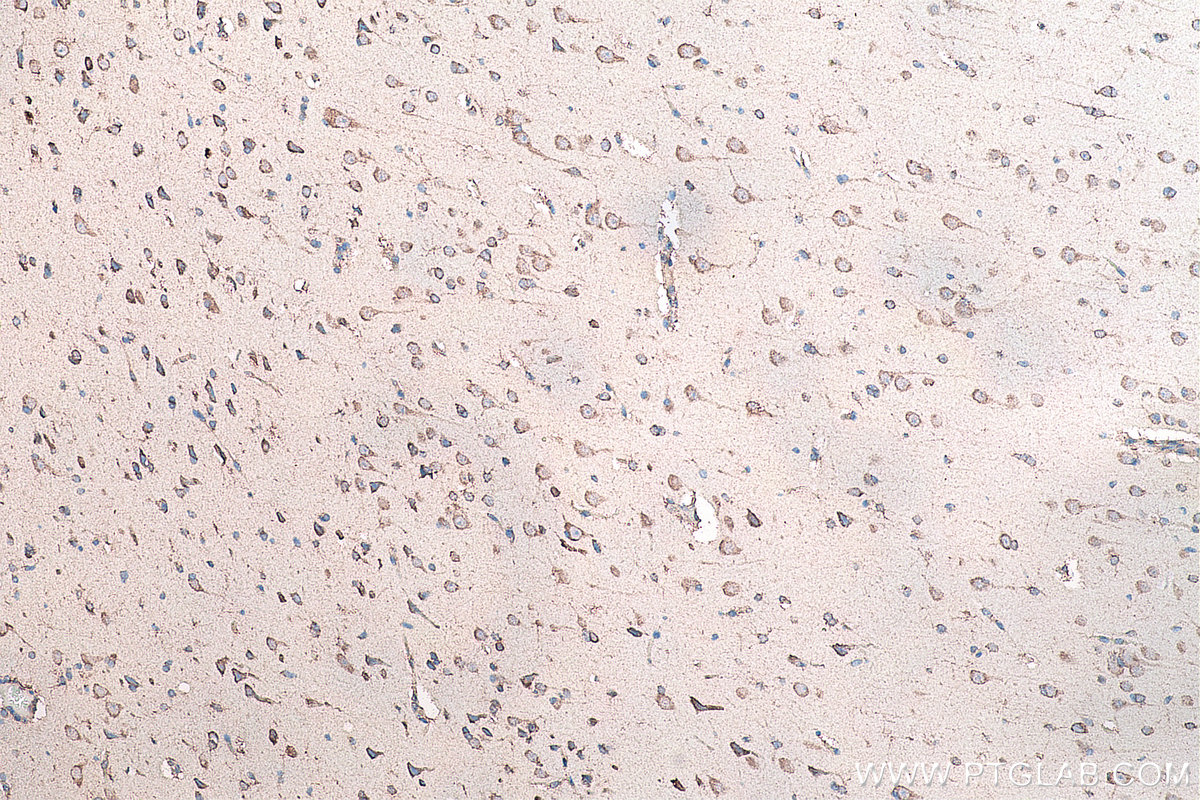 Immunohistochemical analysis of paraffin-embedded human gliomas tissue slide using KHC0124 (DVL2 IHC Kit).