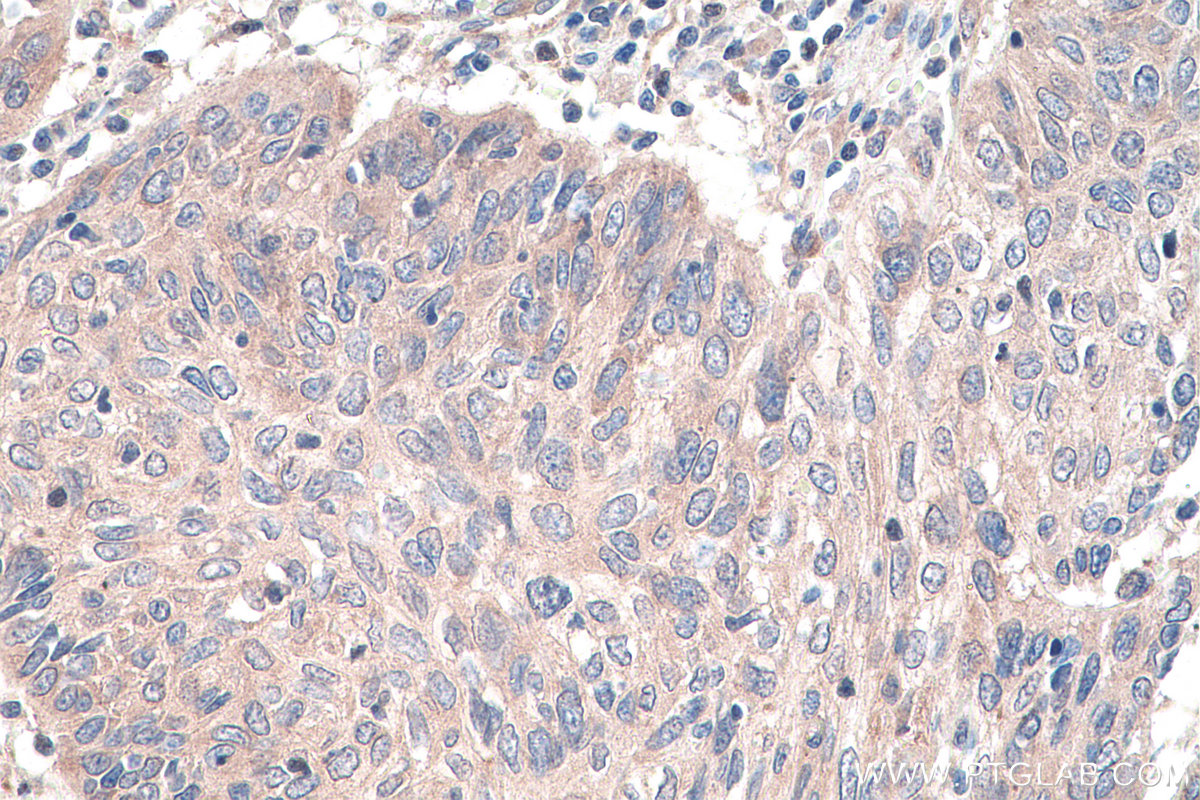 Immunohistochemical analysis of paraffin-embedded human cervical cancer tissue slide using KHC0125 (DVL3 IHC Kit).