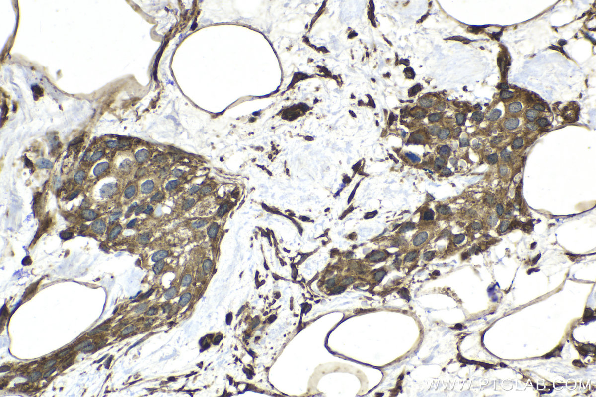 Immunohistochemical analysis of paraffin-embedded human urothelial carcinoma tissue slide using KHC2055 (DYNC1I1 IHC Kit).