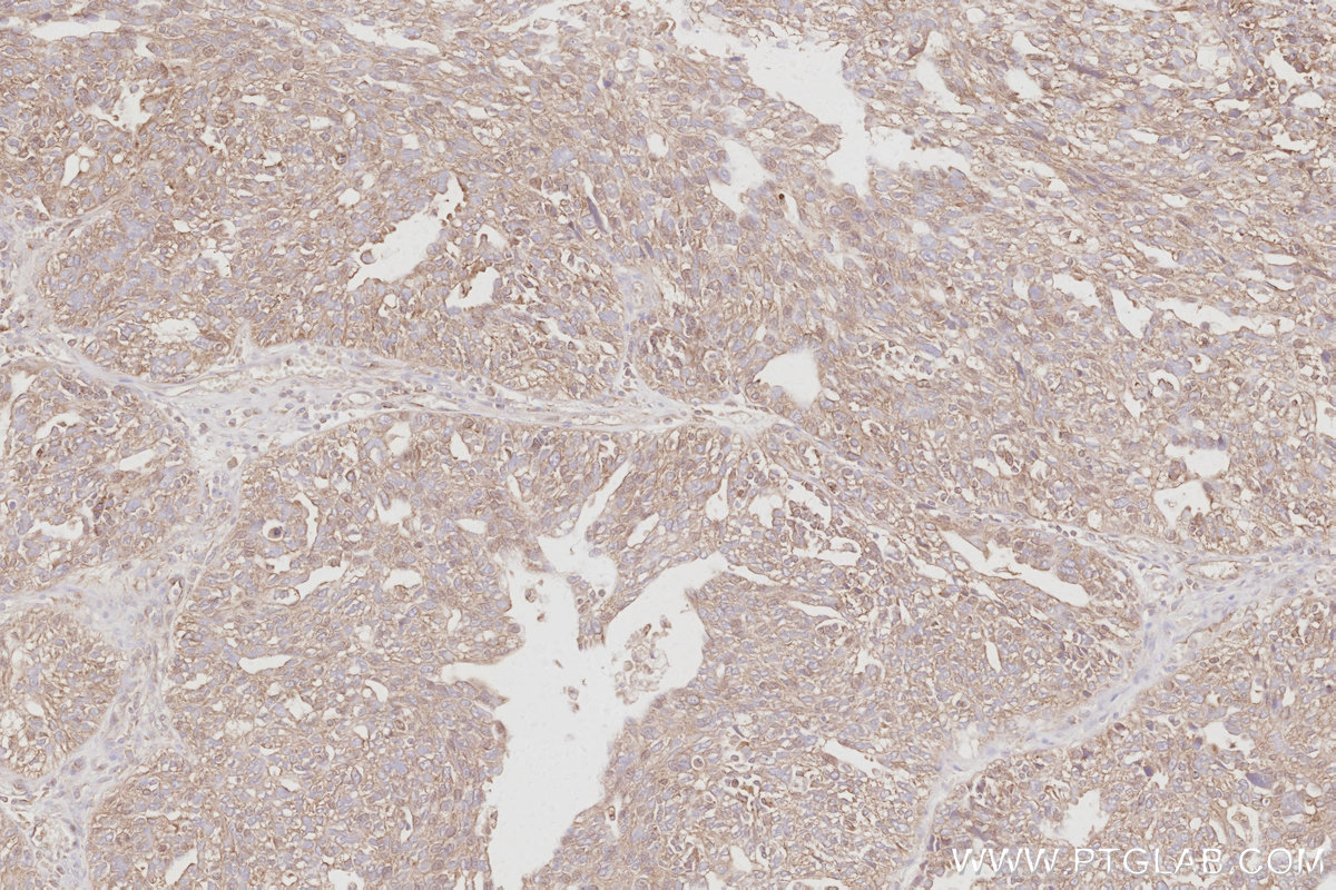 Immunohistochemical analysis of paraffin-embedded human ovary cancer tissue slide using KHC3091 (DYNC1LI1 IHC Kit).