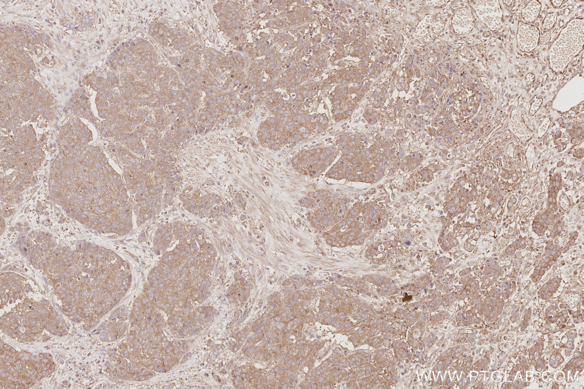 Immunohistochemical analysis of paraffin-embedded human stomach cancer tissue slide using KHC3091 (DYNC1LI1 IHC Kit).
