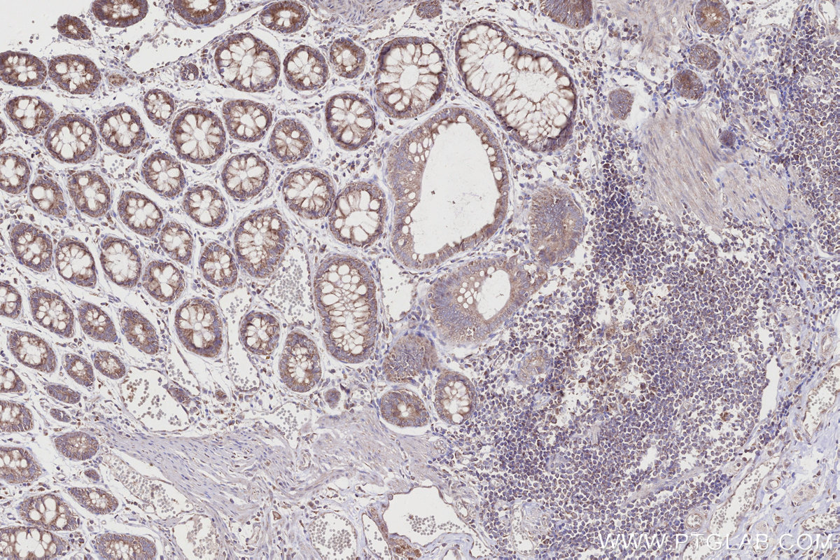 Immunohistochemical analysis of paraffin-embedded human rectal cancer tissue slide using KHC2750 (DYRK2 IHC Kit).