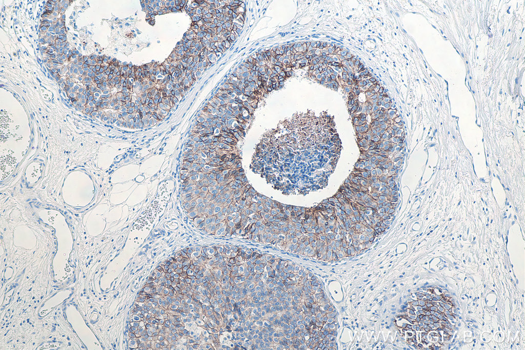 Immunohistochemical analysis of paraffin-embedded human breast cancer tissue slide using KHC0010 (E-cadherin IHC Kit)