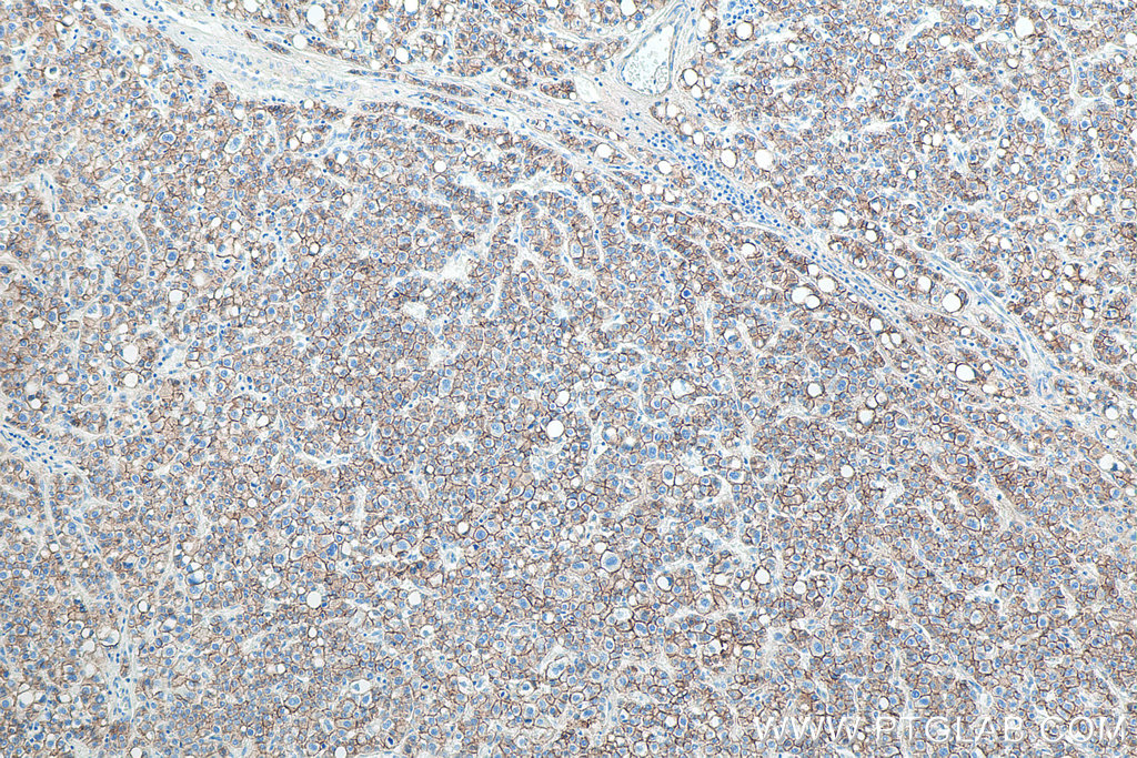 Immunohistochemical analysis of paraffin-embedded human liver cancer tissue slide using KHC0010 (E-cadherin IHC Kit).