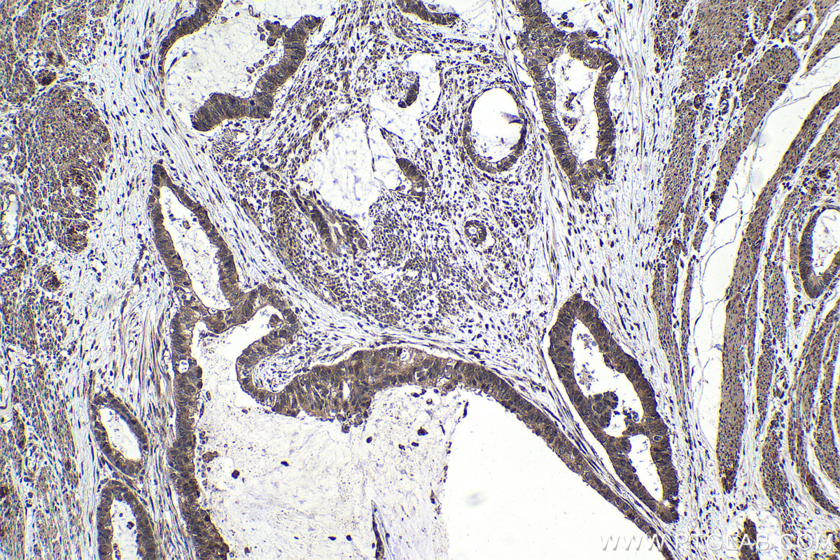 Immunohistochemical analysis of paraffin-embedded human urothelial carcinoma tissue slide using KHC1753 (ECE1 IHC Kit).