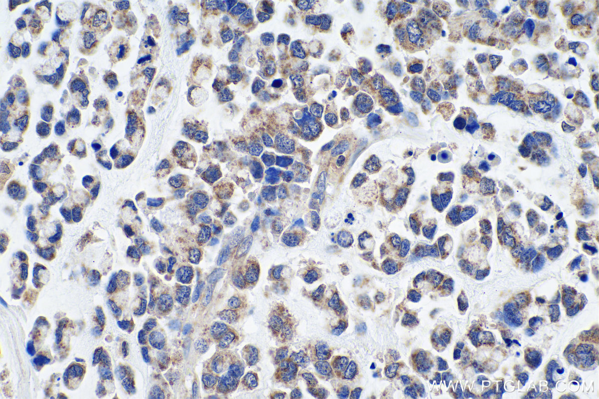 Immunohistochemical analysis of paraffin-embedded human colon cancer tissue slide using KHC0933 (ECHDC1 IHC Kit).
